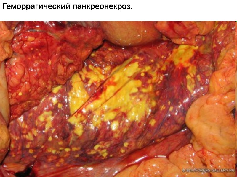 Геморрагический панкреонекроз.